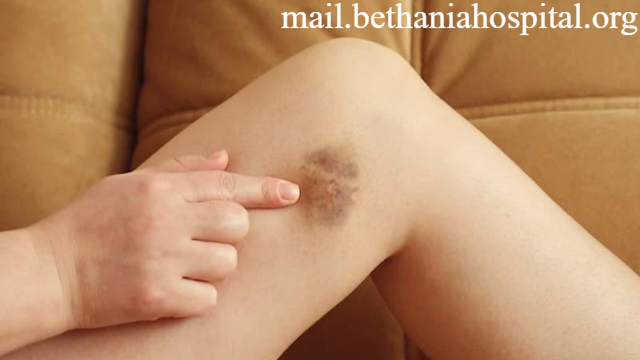 Metode Menghilangkan Bekas Luka yang Menghitam